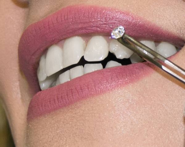 Pose de bijoux dentaires